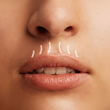 Lippenfältchen und Raucherfältchen unterspritzen und glätten bei Dr. Tschager